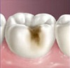 caries dental