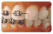 aparatos de ortodoncia