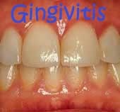 periodoncia gingivitis